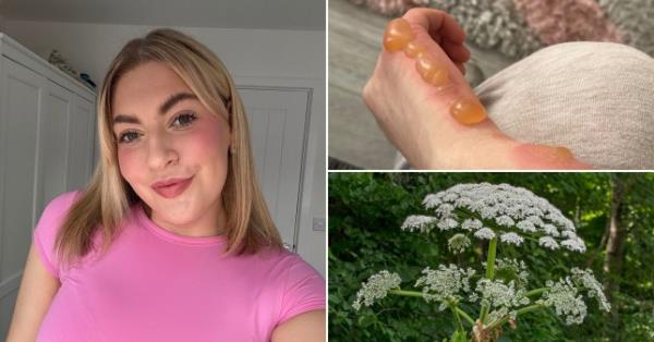 Chloe Douglas, 20, suffered gruesome injuries to her hand (Picture: Chloe Douglas/Pen News)